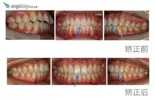 咬后槽牙是什么意思